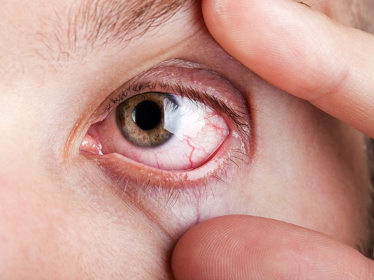 Ojos secos: ¿por qué aparecen y cómo elegir las mejores lágrimas artificiales?