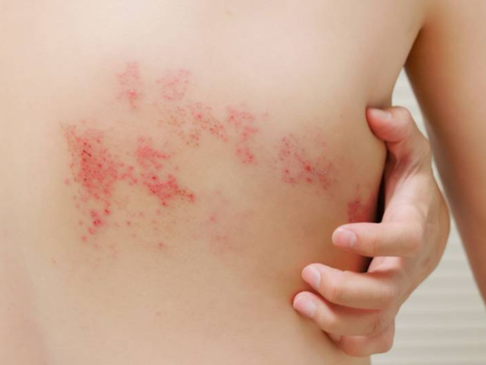 Si tienes mas de 50 años deberías saber esto sobre la Vacuna del Herpes